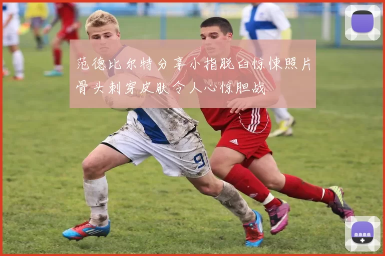 范德比尔特分享小指脱臼惊悚照片骨头刺穿皮肤令人心惊胆战